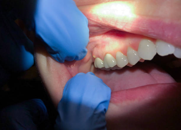 Best Emergency Dental Filling Replacement  in Omaha, TX